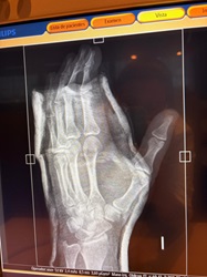 Contusion y Hematoma 3.JPG (3034448 bytes)